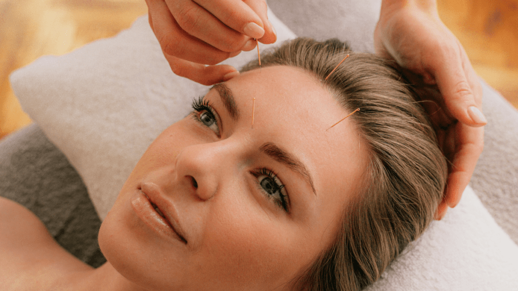Βελονισμός προσώπου | Treatwell