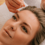 Βελονισμός προσώπου | Treatwell